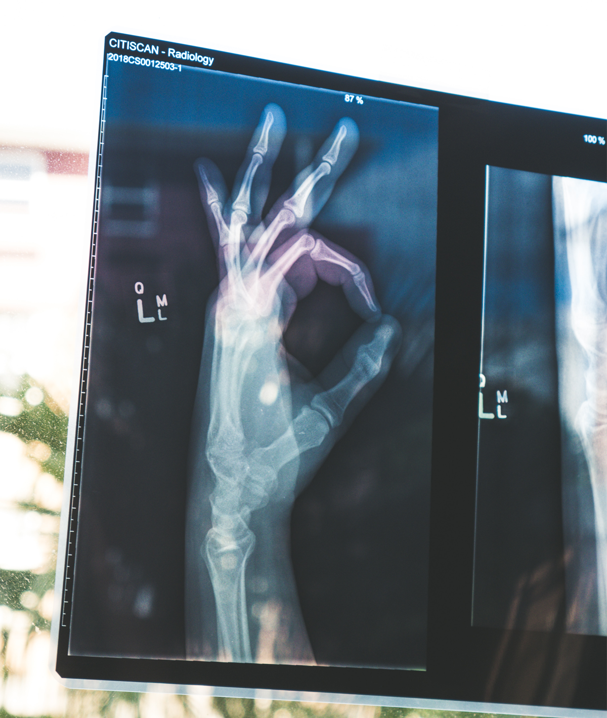X ray of hand showing the