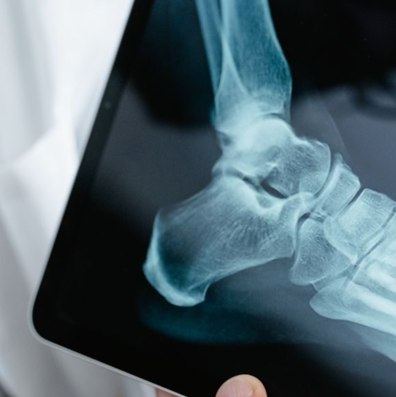 X Ray image of an ankle